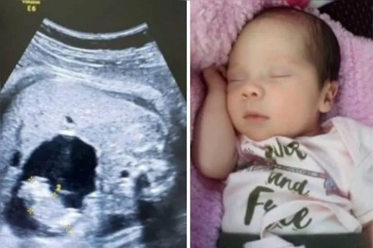 Imagem ilustrativa da imagem Condição rara faz bebê nascer 'grávida'